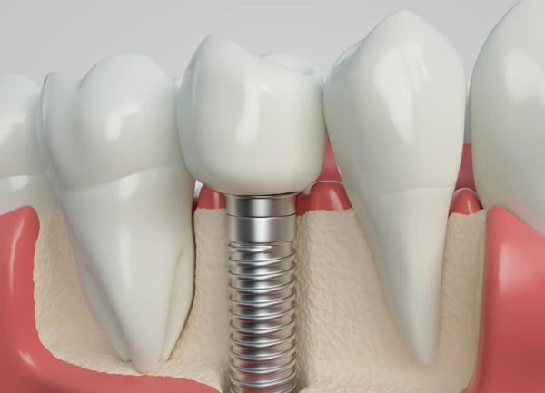 dentiste paris 15 implant